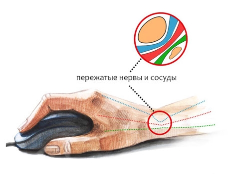 Запястный туннельный синдром